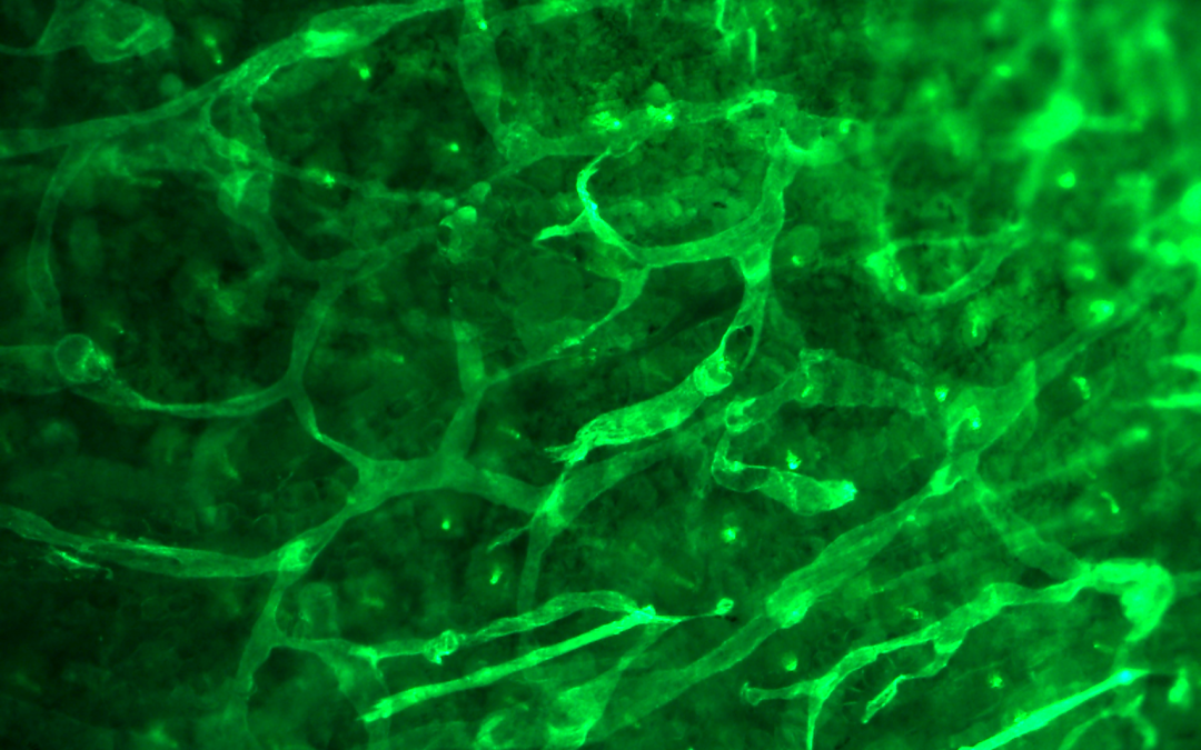 Click here to discover Theralymph Gene therapy for lymphedema