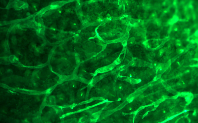 Click here to discover Theralymph Gene therapy for lymphedema